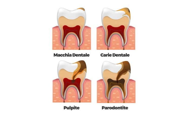 Pulpite dentale cos è cause sintomi e cura Dental Factor