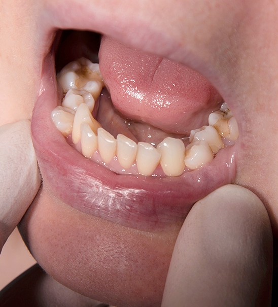 malocclusioni-dentali