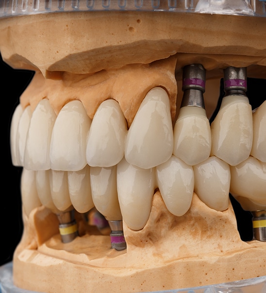 protesi-dentali-fisse