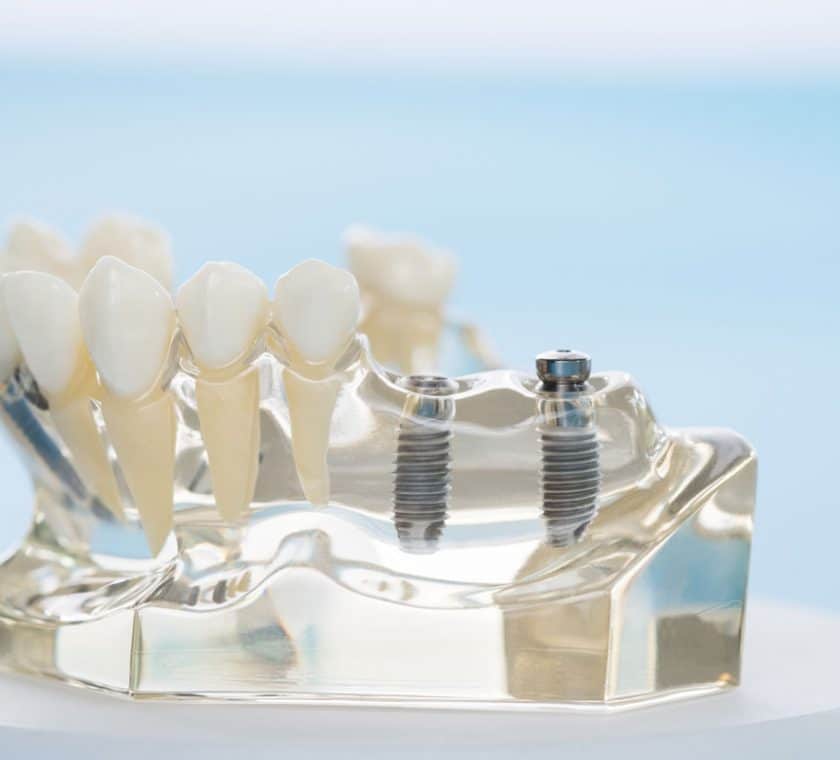 Impianti dentali a carico immediato per denti fissi in un solo giorno