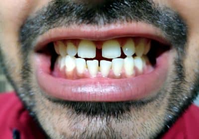 correggere il diastema dentale con l'ortodonzia