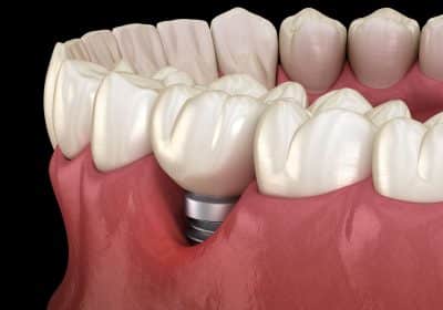 impianti dentali e parodontite