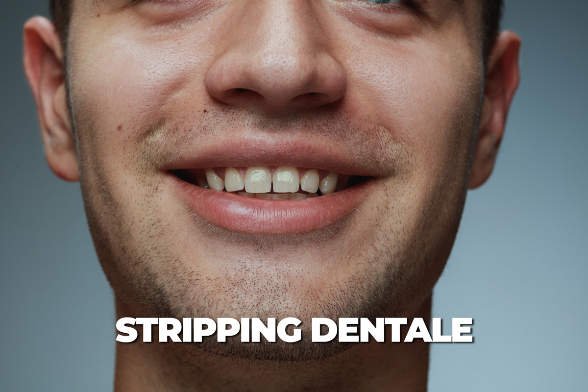 Stripping dentale: cos'è e come funziona in ortodonzia