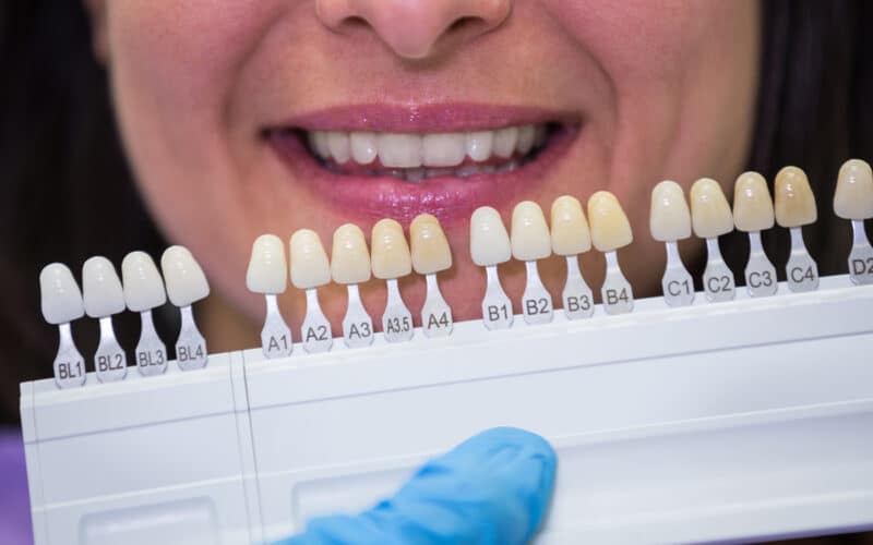 Costo faccette dentali – Il prezzo per un sorriso perfetto nel 2024